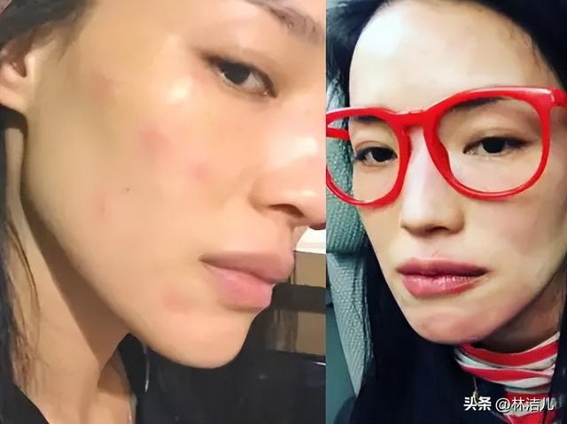 女明星也有换季皮肤问题？舒淇深受过敏困扰，杨紫更是爱出荨麻疹-2.jpg
