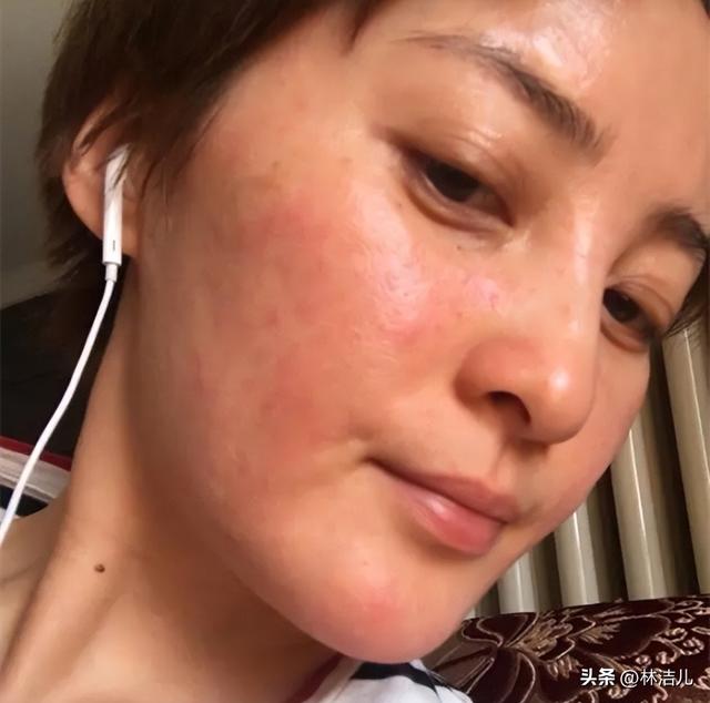 女明星也有换季皮肤问题？舒淇深受过敏困扰，杨紫更是爱出荨麻疹-3.jpg