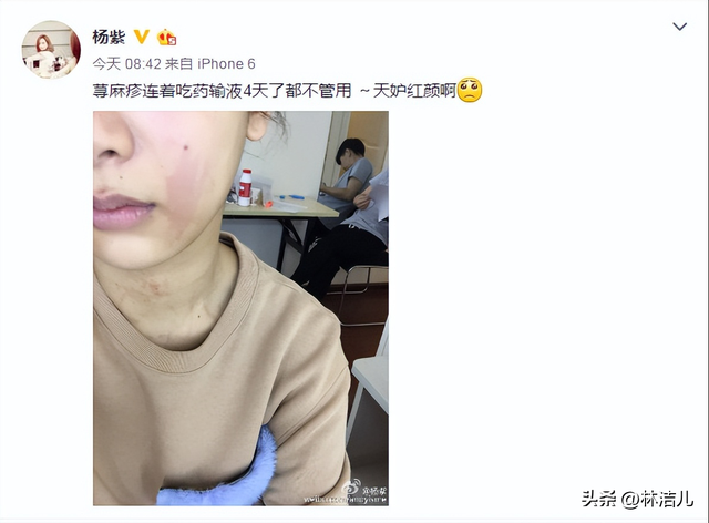 女明星也有换季皮肤问题？舒淇深受过敏困扰，杨紫更是爱出荨麻疹-4.jpg